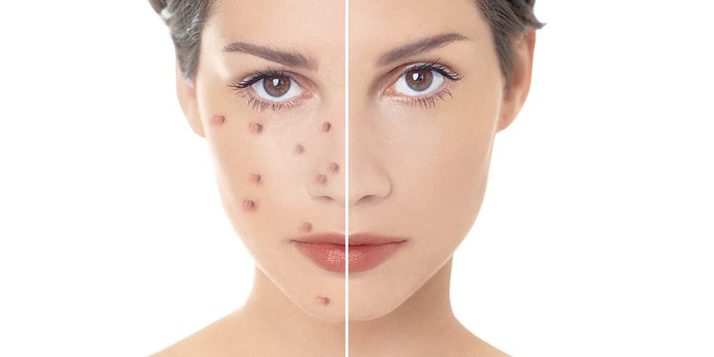 Read more about the article How to Get Rid of Acne Quickly